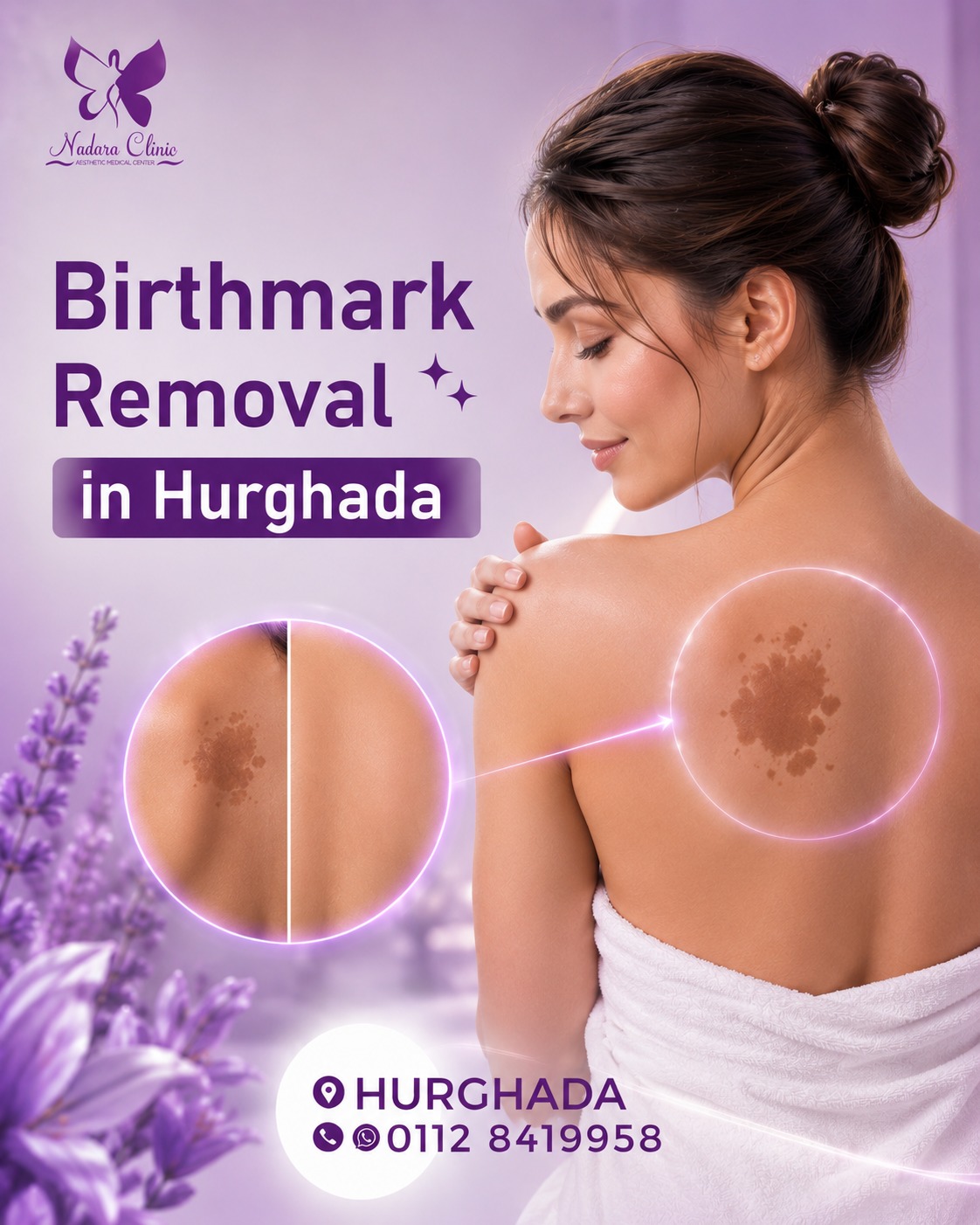 Birthmark removal in Hurghada